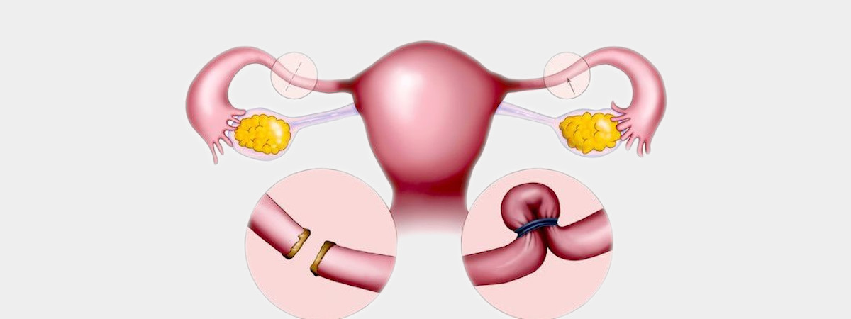 απολίνωση σαλπίγγων