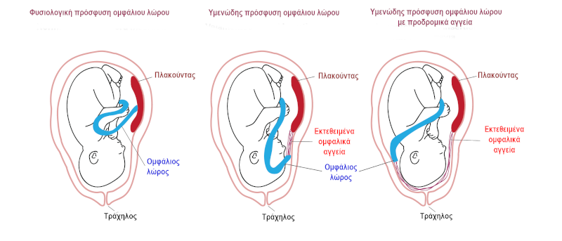 Υμενώδης πρόσφυση ομφάλιου λώρουΥμενώδης πρόσφυση ομφάλιου λώρου